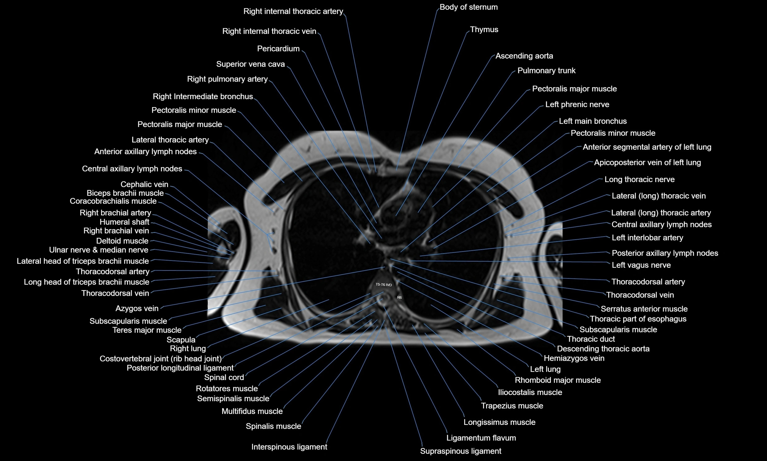 MRI chest axial  cross sectional anatomy 3T radiology  image-img-00001-00020.webp